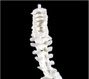 Reconstruction of Richard III's spine. The Lancet