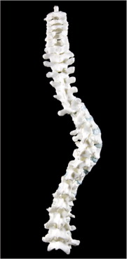 Reconstruction of Richard III's spine. The Lancet